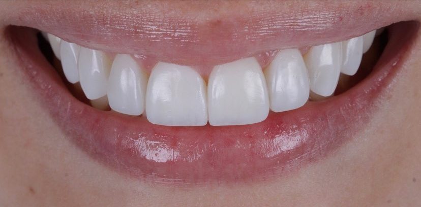 Sorriso após tratamento com lentes de contato dental na clínica
