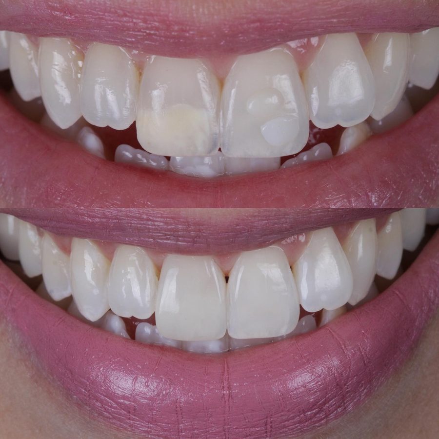 Antes e depois do sorriso de um paciente da clínica, caso real 1