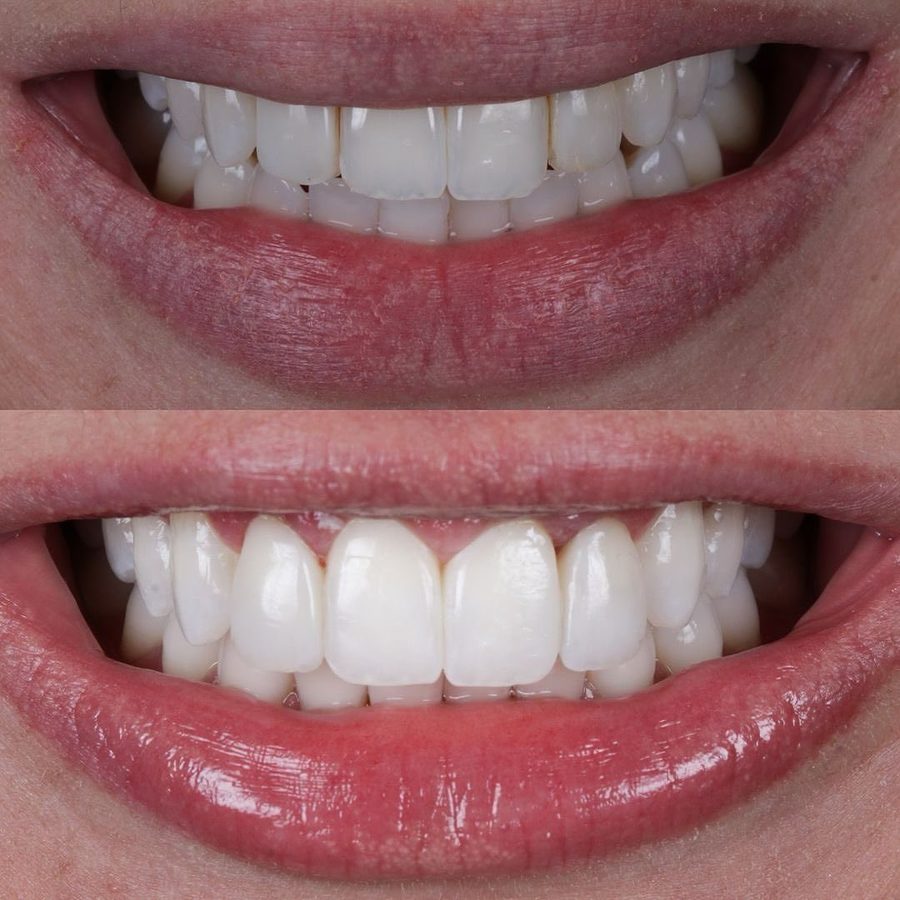 Antes e depois do sorriso de um paciente da clínica, caso real 3