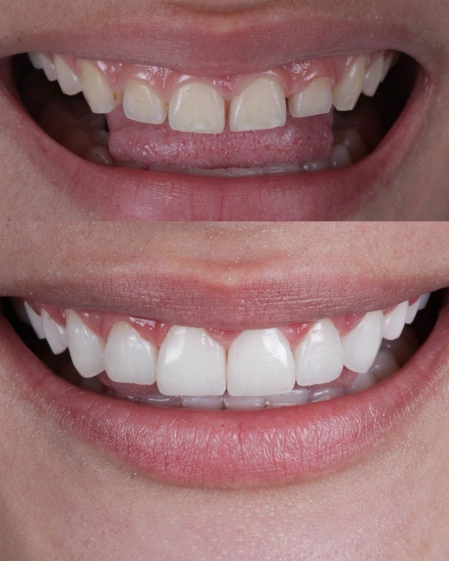 Antes e depois do sorriso de um paciente da clínica, caso real 4