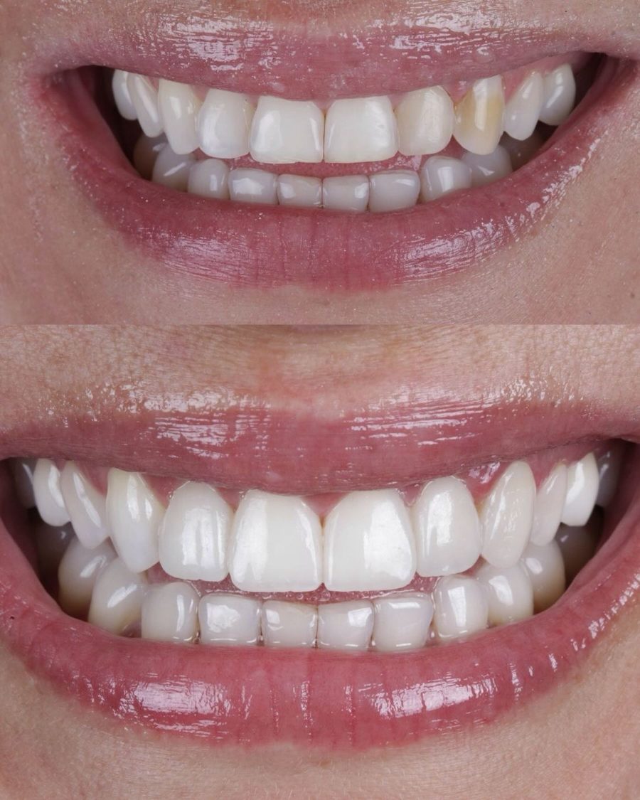 Antes e depois do sorriso de um paciente da clínica, caso real 5